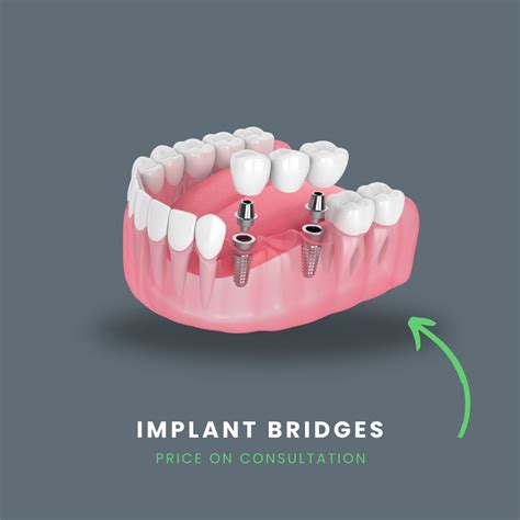 bridge implant in ashford|Dental Bridge Application in Ashford .